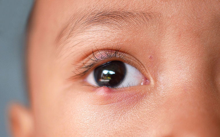 Stye and Chalazion: What To Do