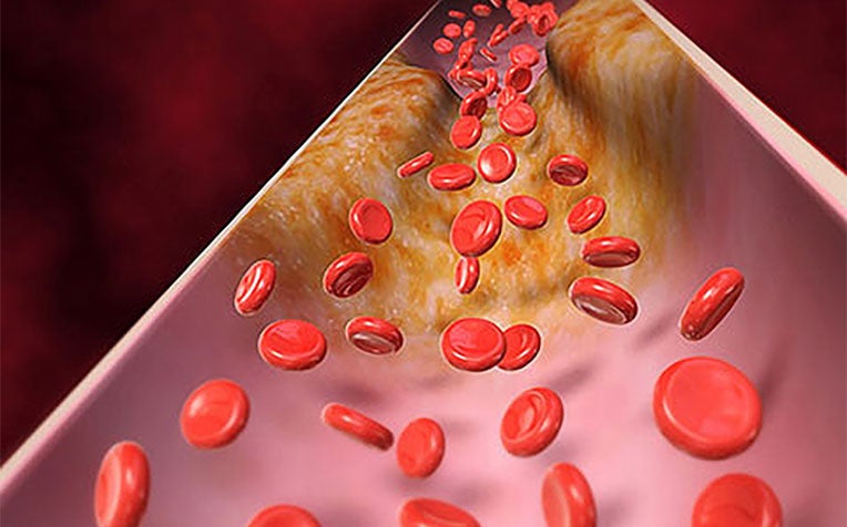 LDL (Bad Cholesterol): How to Lower and Why